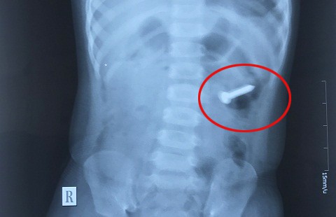 Bé gái 2 tuổi nuốt đinh xoắn 3cm - Ảnh 1. Bé gái 2 tuổi nuốt đinh xoắn 3cm - Ảnh 1.
