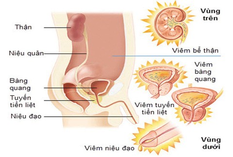 Dấu hiệu của viêm đường tiết niệu - Ảnh 1. Dấu hiệu của viêm đường tiết niệu - Ảnh 1.