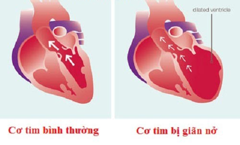 Căn bệnh nào được xem là ung thư của tim? - Ảnh 1. Căn bệnh nào được xem là ung thư của tim? - Ảnh 1.