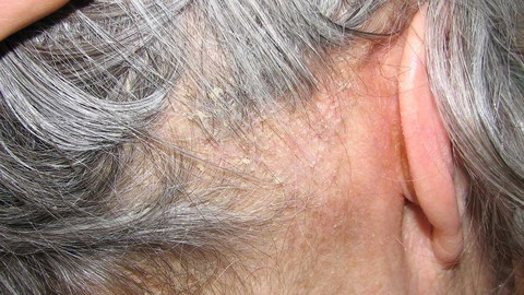 Những điều cần biết về viêm da tiết bã - Ảnh 1. Những điều cần biết về viêm da tiết bã - Ảnh 1.