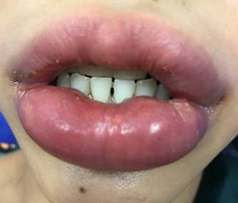 Lại một phụ nữ gặp tai biến vì bơm môi ở thẩm mỹ viện - Ảnh 1. Lại một phụ nữ gặp tai biến vì bơm môi ở thẩm mỹ viện - Ảnh 1.