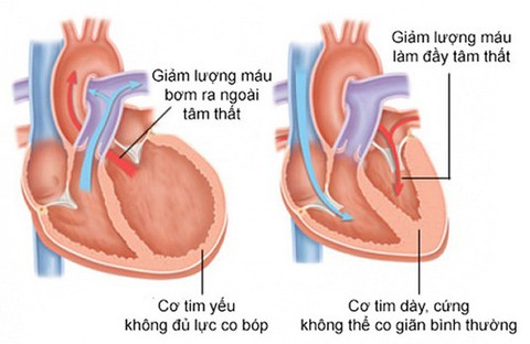 Những lưu ý trong điều trị suy tim - Ảnh 1. Những lưu ý trong điều trị suy tim - Ảnh 1.