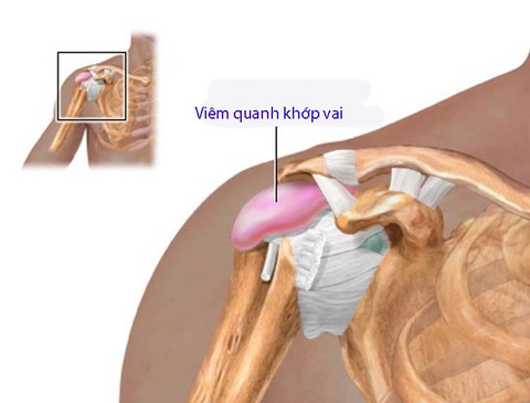 Viêm quanh khớp vai thể đông đặc - Ảnh 1. Viêm quanh khớp vai thể đông đặc - Ảnh 1.