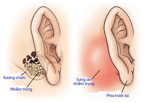 Viêm xương chũm - Ảnh 1. Viêm xương chũm - Ảnh 1.