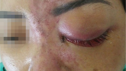 Quá nguy hiểm khi tiêm chất làm đầy - Ảnh 1. Quá nguy hiểm khi tiêm chất làm đầy - Ảnh 1.