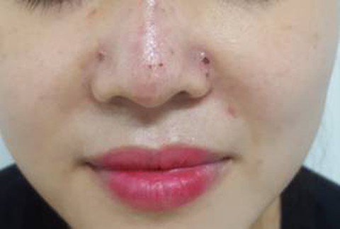 Tiêm filler nâng mũi, một phụ nữ bị biến chứng - Ảnh 1. Tiêm filler nâng mũi, một phụ nữ bị biến chứng - Ảnh 1.