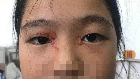 Cháu bé mắc bệnh đổ mồ hôi máu hiếm gặp - Ảnh 1. Cháu bé mắc bệnh đổ mồ hôi máu hiếm gặp - Ảnh 1.