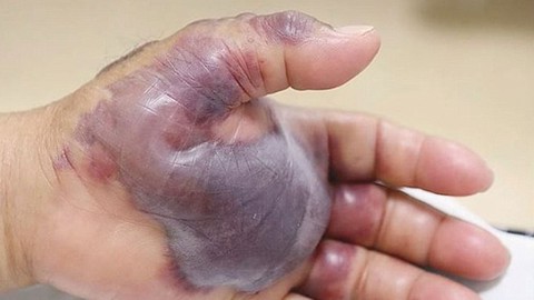 Ăn hải sản sống coi chừng khuẩn ăn thịt người - Ảnh 1. Ăn hải sản sống coi chừng khuẩn ăn thịt người - Ảnh 1.
