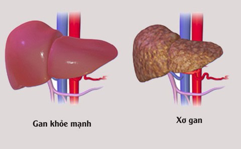 Biến chứng của xơ gan - Ảnh 1. Biến chứng của xơ gan - Ảnh 1.