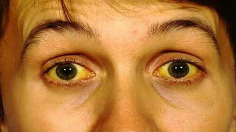 Viêm gan siêu vi A: Bệnh lây qua đường tiêu hóa - Ảnh 1. Viêm gan siêu vi A: Bệnh lây qua đường tiêu hóa - Ảnh 1.
