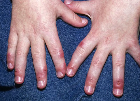 Những bệnh gây khó chịu trong mùa đông - Ảnh 1. Những bệnh gây khó chịu trong mùa đông - Ảnh 1.
