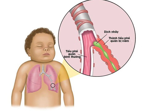 Bệnh viêm tiểu phế quản ở trẻ - Ảnh 1. Bệnh viêm tiểu phế quản ở trẻ - Ảnh 1.