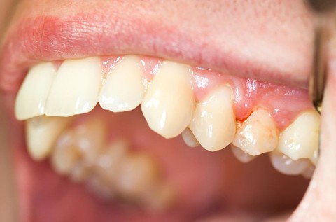 Các bệnh răng miệng thường gặp - Ảnh 1. Các bệnh răng miệng thường gặp - Ảnh 1.