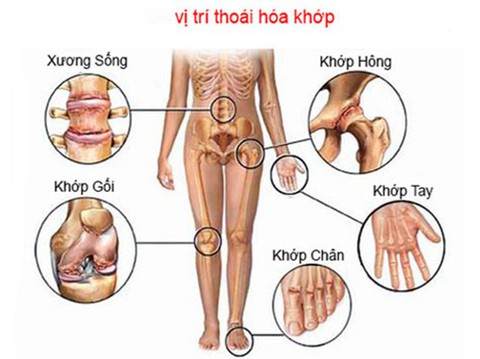 Thoái hóa khớp ở người cao tuổi - Ảnh 1. Thoái hóa khớp ở người cao tuổi - Ảnh 1.
