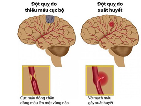 Đột quỵ não và khoảng “thời gian vàng” cho hồi phục - Ảnh 1. Đột quỵ não và khoảng “thời gian vàng” cho hồi phục - Ảnh 1.