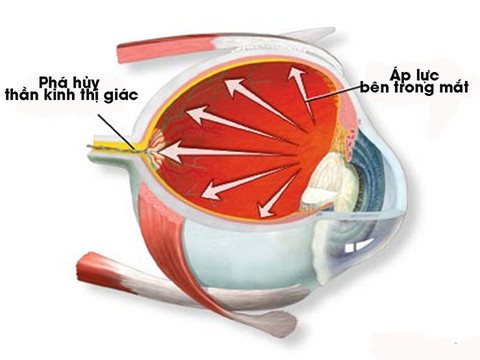 Không chủ quan với bệnh thiên đầu thống - Ảnh 1. Không chủ quan với bệnh thiên đầu thống - Ảnh 1.
