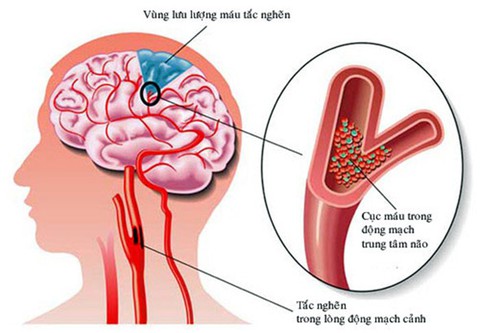 Dấu hiệu và cách xử trí cơn thiếu máu não thoáng qua - Ảnh 1. Dấu hiệu và cách xử trí cơn thiếu máu não thoáng qua - Ảnh 1.