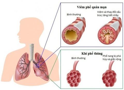 Ai có nguy cơ mắc bệnh phổi tắc nghẽn mạn tính? - Ảnh 1. Ai có nguy cơ mắc bệnh phổi tắc nghẽn mạn tính? - Ảnh 1.