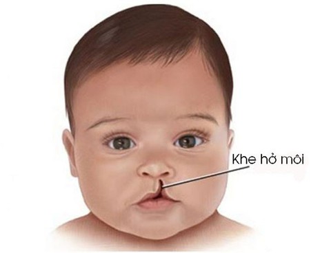 Chăm sóc trẻ bị khe hở môi trước và sau phẫu thuật - Ảnh 1. Chăm sóc trẻ bị khe hở môi trước và sau phẫu thuật - Ảnh 1.