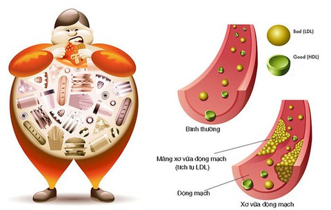 Tác hại do tăng mỡ máu và cách kiểm soát - Ảnh 1. Tác hại do tăng mỡ máu và cách kiểm soát - Ảnh 1.
