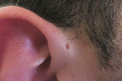 Dị tật rò luân nhĩ ở trẻ - Bệnh chớ nên xem thường - Ảnh 1. Dị tật rò luân nhĩ ở trẻ - Bệnh chớ nên xem thường - Ảnh 1.