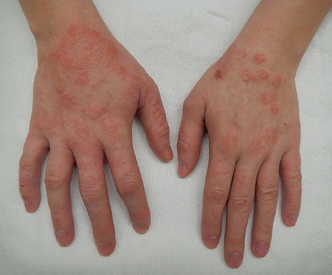 Một số thuốc điều trị viêm da cơ địa - Ảnh 1. Một số thuốc điều trị viêm da cơ địa - Ảnh 1.