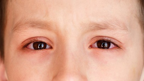 Viêm kết mạc mùa đông xuân - Ảnh 1. Viêm kết mạc mùa đông xuân - Ảnh 1.