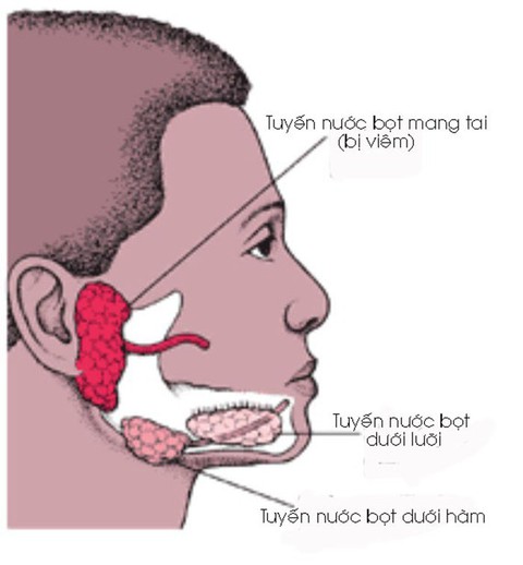Bệnh quai bị và cách phòng ngừa - Ảnh 1. Bệnh quai bị và cách phòng ngừa - Ảnh 1.