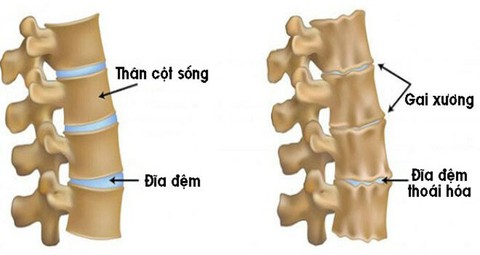 Chữa gai cột sống, vôi hóa cột sống - Ảnh 1. Chữa gai cột sống, vôi hóa cột sống - Ảnh 1.