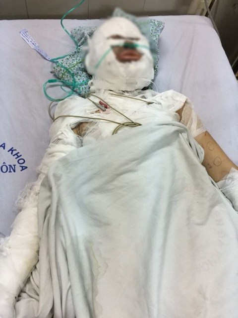 Điều tra vụ một phụ nữ bị tình nhân người nước ngoài đốt - Ảnh 1. Điều tra vụ một phụ nữ bị tình nhân người nước ngoài đốt - Ảnh 1.