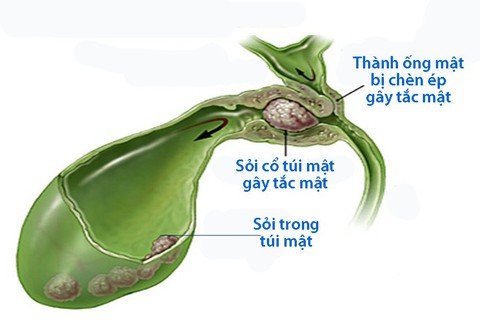 Bệnh sỏi mật - Ảnh 1. Bệnh sỏi mật - Ảnh 1.