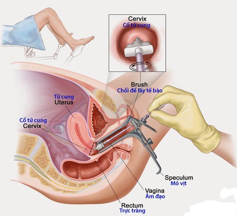Phát hiện sớm ung thư cổ tử cung - Ảnh 1. Phát hiện sớm ung thư cổ tử cung - Ảnh 1.