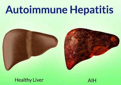 Viêm gan tự miễn trẻ em - Ảnh 1. Viêm gan tự miễn trẻ em - Ảnh 1.