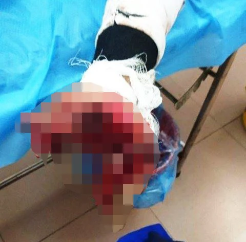 Mất bàn tay khi vừa sạc pin vừa dùng điện thoại - Ảnh 1. Mất bàn tay khi vừa sạc pin vừa dùng điện thoại - Ảnh 1.