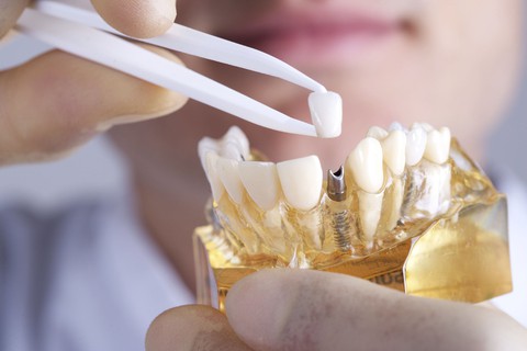 Điều trị thế nào khi trụ răng Implant bị xô lệch? - Ảnh 2. Điều trị thế nào khi trụ răng Implant bị xô lệch? - Ảnh 2.