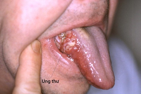Một số điểm cần chú ý trong ung thư khoang miệng - Ảnh 1. Một số điểm cần chú ý trong ung thư khoang miệng - Ảnh 1.