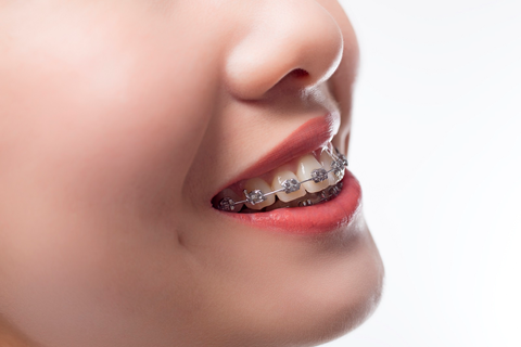 Giải pháp hiệu quả, thẩm mỹ khi niềng răng hô - Ảnh 3. Giải pháp hiệu quả, thẩm mỹ khi niềng răng hô - Ảnh 3.