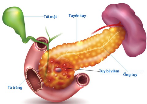 Bệnh viêm tụy cấp - Ảnh 1. Bệnh viêm tụy cấp - Ảnh 1.