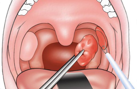 Chăm sóc trẻ phẫu thuật nạo VA, cắt amidan - Ảnh 1. Chăm sóc trẻ phẫu thuật nạo VA, cắt amidan - Ảnh 1.