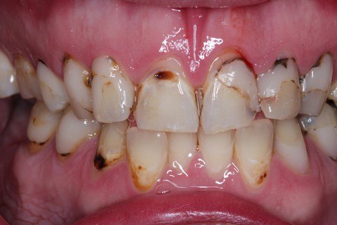 Mòn-tiêu cổ răng - Ảnh 1. Mòn-tiêu cổ răng - Ảnh 1.