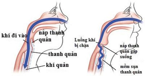 Mềm sụn thanh quản - Ảnh 1. Mềm sụn thanh quản - Ảnh 1.