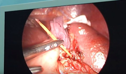 Nhậu quá chén ngậm cây tăm ngủ quên, thủng luôn lá lách - Ảnh 1. Nhậu quá chén ngậm cây tăm ngủ quên, thủng luôn lá lách - Ảnh 1.