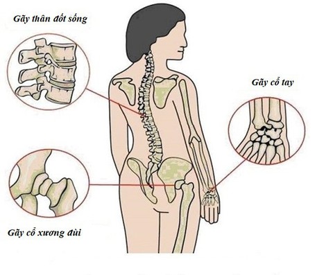 Đừng đợi đến khi bác sĩ kết luận bị loãng xương mới bổ sung canxi - Ảnh 1. Đừng đợi đến khi bác sĩ kết luận bị loãng xương mới bổ sung canxi - Ảnh 1.