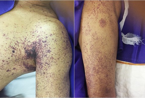 Nguy kịch vì ăn tiết canh lợn - Ảnh 1. Nguy kịch vì ăn tiết canh lợn - Ảnh 1.