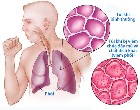 Hiểu đúng về viêm phổi - Ảnh 1. Hiểu đúng về viêm phổi - Ảnh 1.