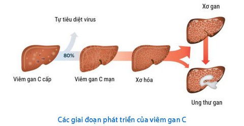 Biểu hiện viêm gan C ở phụ nữ - Ảnh 1. Biểu hiện viêm gan C ở phụ nữ - Ảnh 1.