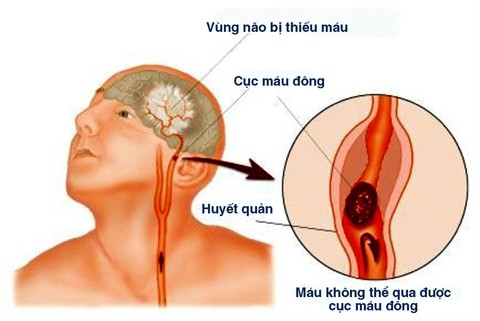 Bệnh nhồi máu não - Ảnh 1. Bệnh nhồi máu não - Ảnh 1.