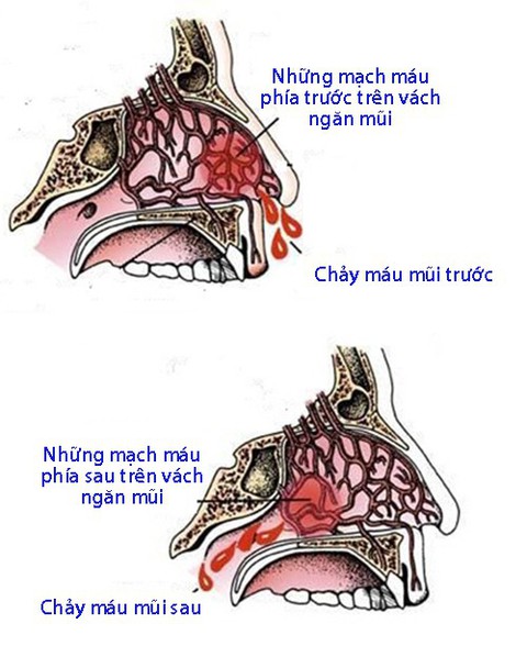 Chảy máu mũi - Ảnh 1. Chảy máu mũi - Ảnh 1.