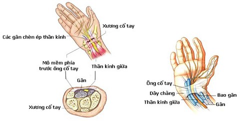 Tê hai bàn tay - Ảnh 1. Tê hai bàn tay - Ảnh 1.