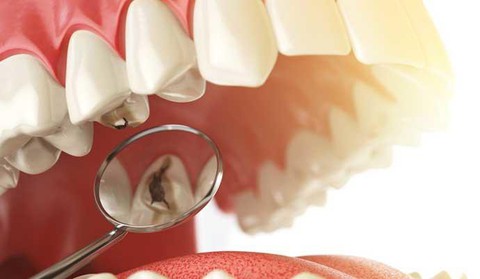 Bọc răng sứ cho răng sâu được không? - Ảnh 4. Bọc răng sứ cho răng sâu được không? - Ảnh 4.